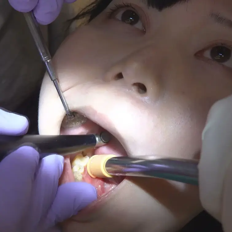 【4K歯科治療 由宇 Ver.1】

実は虫歯の歯痛から片側にて咬みながら
過ごしてました由宇さん。早速ドクター
から右下の臼歯部の治療痕の下に潜むう蝕に麻酔を施しまして反対側の治療と
しまして左下のう蝕に侵された部分の処置からスタート致します。いよいよ7番
と6番に跨る二次う蝕がある右下の治療
します。何やら茶色い瞳を見開いて今
治療の苦悶の表情の由宇さん。少し削り
またう蝕の深い部位まで取り除きます‥

続いて反対側の治療も再びスタートです
と虫歯に侵された部位も削りまして除去
します。もう左下の5番のう蝕も削って
はっきり確認も出来まして治療を再び
堪える由宇さんのう蝕は大臼歯の6番と
7番に跨る二次う蝕が僅かばかり反対側
と同じくありまして少し削りながら除去
しますのでレジン充填が施されます。

そして飛散防止の所謂タオルに目隠しの由宇さんの治療も見守り下さい。反対側
から左下のう蝕の処置の仕上げに入ると
相前後の治療に疲労困憊の由宇さん。

もう仕上げに入るドクター。まだまだ今
治療が不可欠の由宇さんを引き続きご覧
下さい。また近日中に治療が続きます‥

【歯科治療動画】
 　42分33秒
 出演：由宇
ファイル形式：MP4
フレーム：3840×2160

 【注意事項】
 ※撮影は出演者の許諾を得て撮影しています。
 ※商品は出演者のプライバシー保護の観点から予告なく削除することがございます。
 ※二次使用、譲渡、転載、転売等は禁止します。
 ※スクリーンショット、画面収録等を利用しての個人での保存も禁止します。