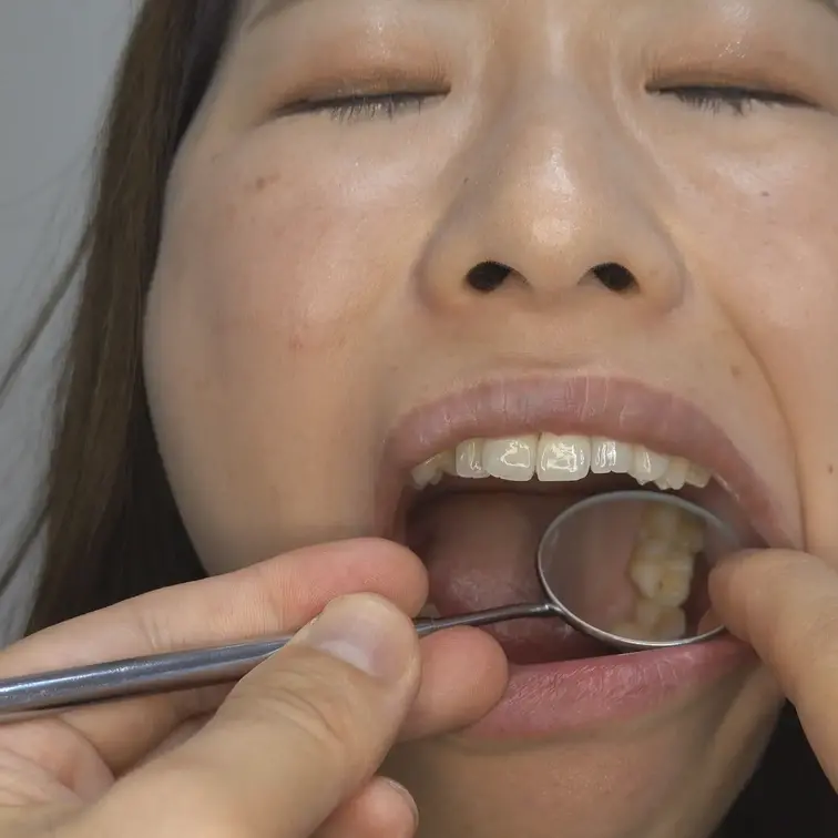 【4K口腔内観察 優里】

スレンダーな人妻の優里さん。実に八重歯がチャームポイントな彼女も今現在は
歯に問題はなさげな模様でして歯科医へ
毎月の定期検診も欠かさぬ優等生です

‥って顎関節病が見受けられるのも撮影
当日まで気付かなかった優里さん。毎月
ルーティンの歯科医院の定期検診でも気付かぬ彼女の顎関節が奏でます音色？
とも言えぬ音色も見届けて下さい。治療
した歯牙が見当たらぬ具合に美しい優里
さんの口腔内は歯間に目立つプラークと
も言い難い昼食の食べカスが彼方此方
と見受けられます。恐らく昼食のオクラ
とラーメンでしてオクラはオクラでも種
との本人談。しかも歯肉の後退も見られ
全く無自覚であったので驚きも隠せぬ
優里さん。何やら毎月のルーティンの定期検診が歯肉の手入れに繋がった事実も
知り得た彼女はフロスの愛用者の模様‥

実は乳歯の時代は虫歯も割りかしあって
治療の経験まであった優里さん。今現在
歯医者に苦手なイメージは拭えた彼女。
しかしながら削らぬ具合の小さなう蝕
と思われます歯牙も潜む優里さんです‥

【口腔内観察動画】
　58分33秒
出演：優里
ファイル形式：MP4
フレーム：3840×2160

【注意事項】
※撮影は出演者の許諾を得て撮影しています。
※商品は出演者のプライバシー保護の観点から予告なく削除することがございます。
※二次使用、譲渡、転載、転売等は禁止します。
※スクリーンショット、画面収録等を利用しての個人での保存も禁止します。
※無断転載等が発覚した場合、情報開示請求を行った後、著作権法に基づき厳しく対処いたします。