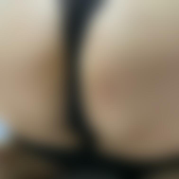 ニキビが…💦