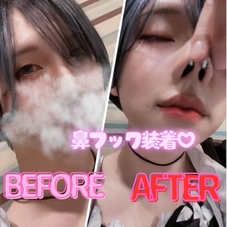 鼻フックを装着する瞬間、鼻が歪むBefore After