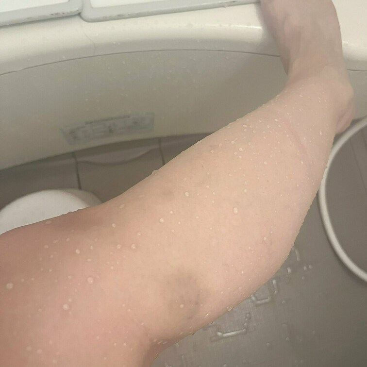 いつの間にやらできてた痣……