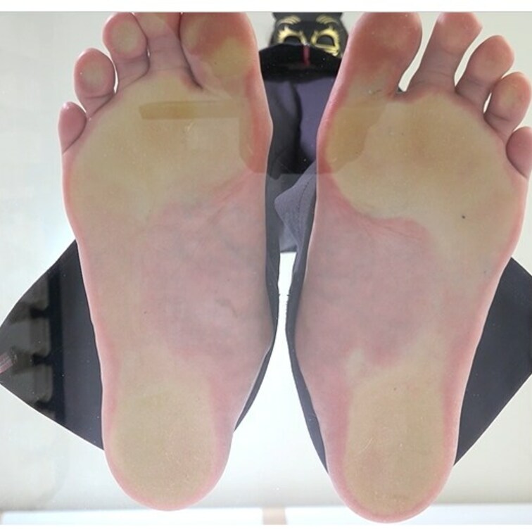 偏平足の足をもつ女性の足裏