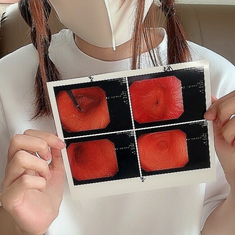 衝撃!水希の胃カメラ写真¥3000
胃の調子悪くて胃カメラやりました(тロт)
頑張った…!!!
痛いーって泣