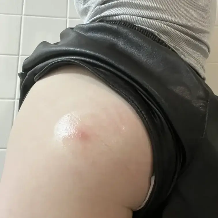 お尻、蚊に咬まれたよー🥺
かゆいー