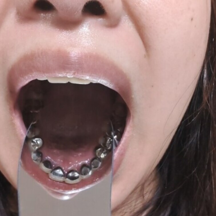 歯の裏を中心に撮影しました、私の歯の裏は特別！おもいっきり銀歯なので歯フェチにはたまらないはず！