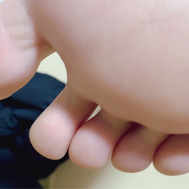 今日むしむし😖のあんよ🐾ᵕ̈